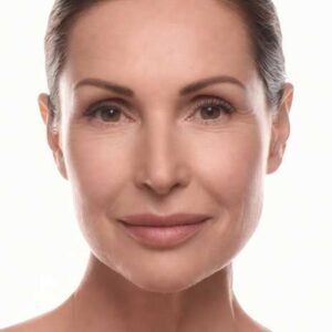 MESOTERAPIA FACIAL CON VITAMINAS